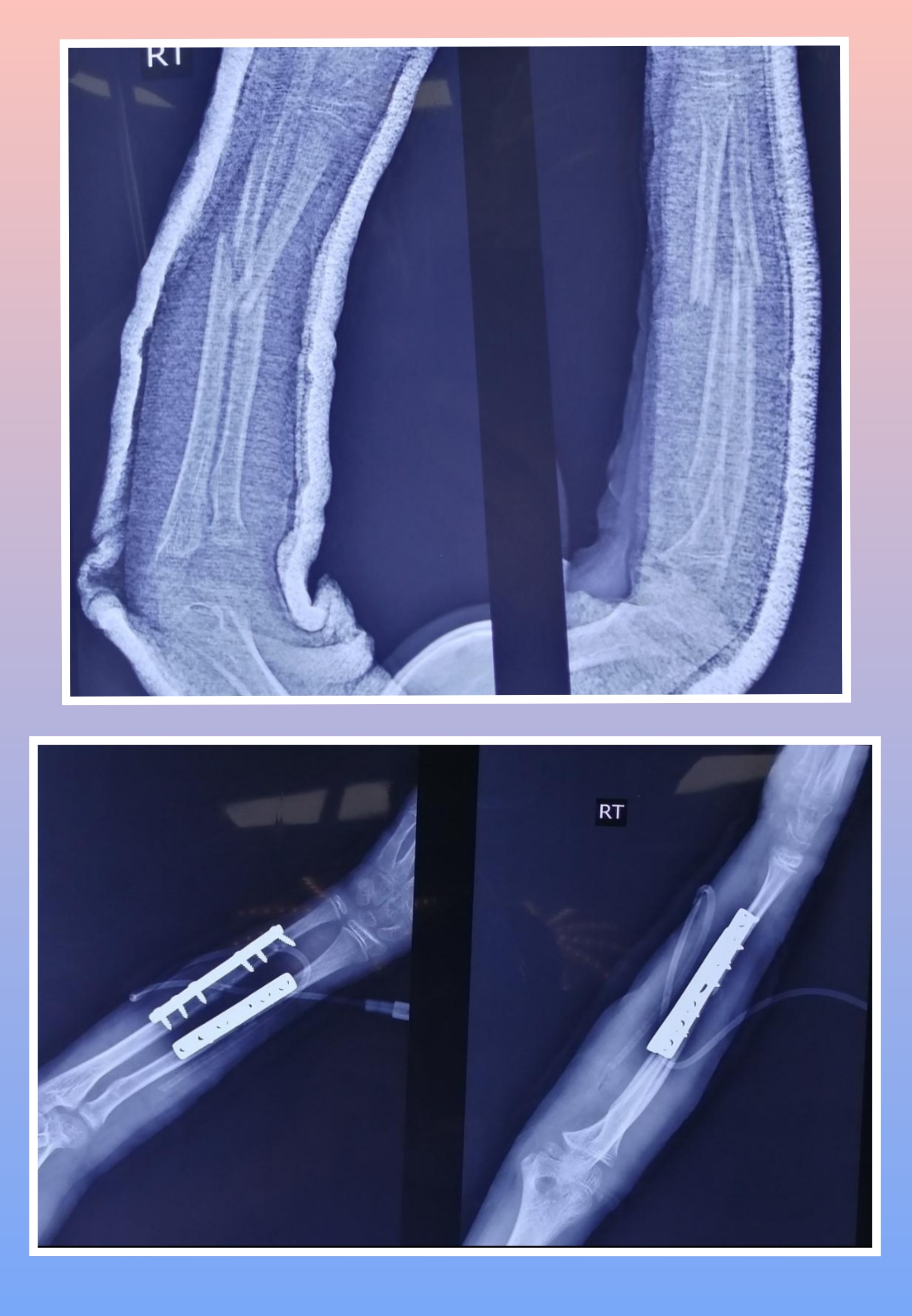 Xray Image