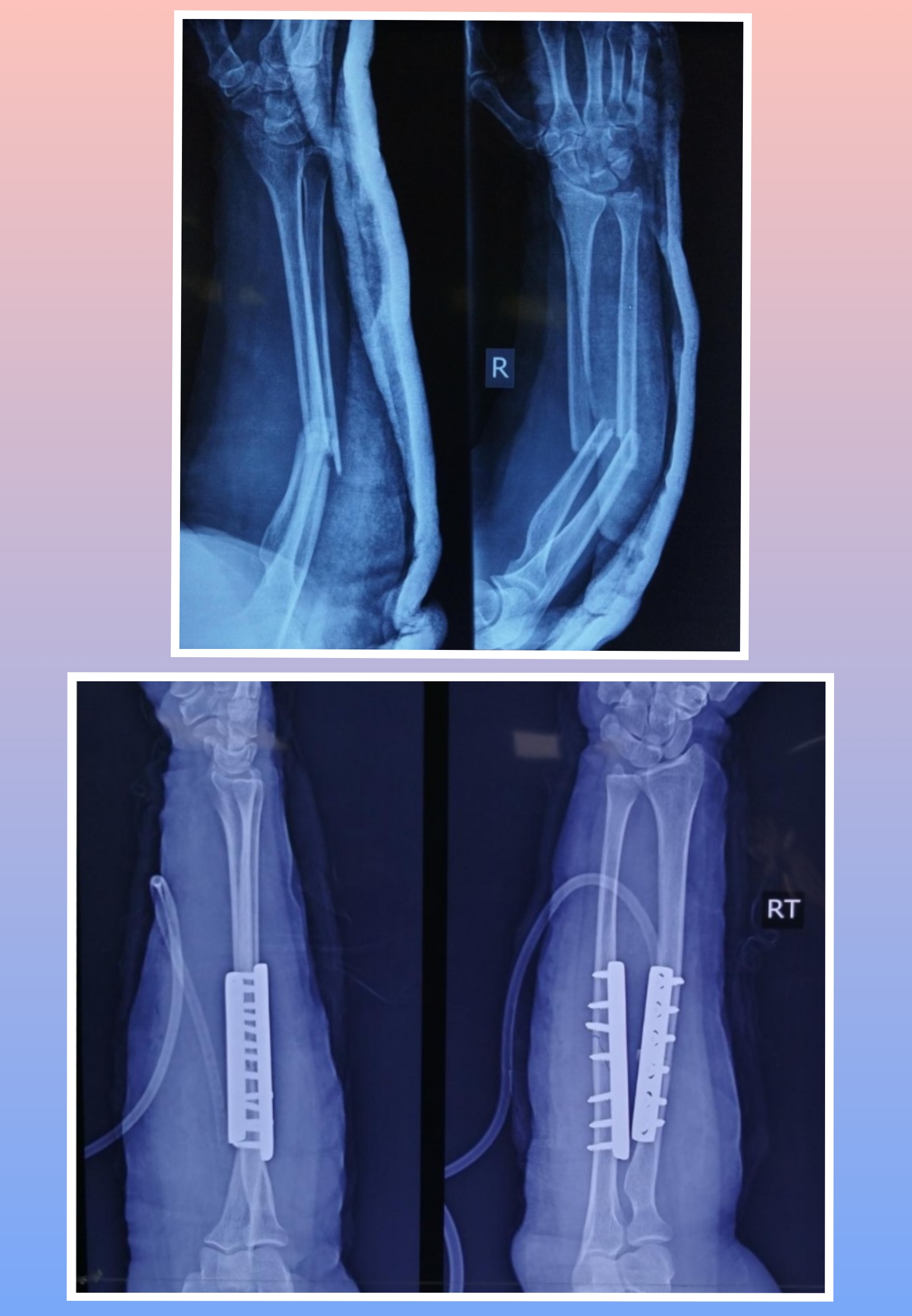 Xray Image